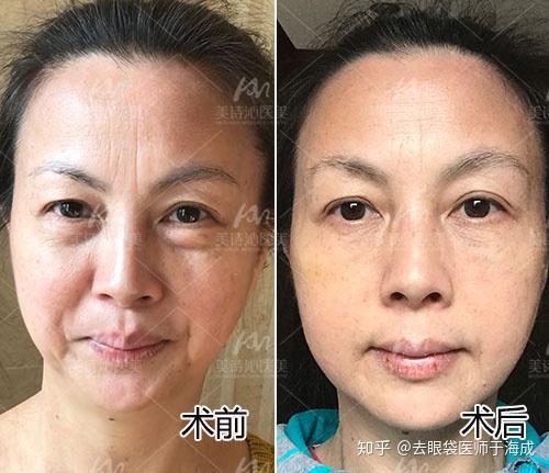 直播去眼袋揭秘，小巷深處的秘密美容寶藏