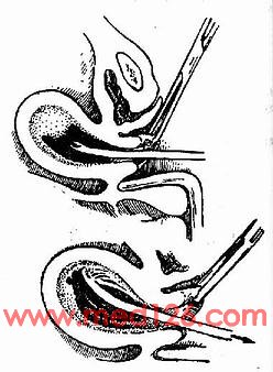 最新流產(chǎn)技術(shù)觀點論述與進展