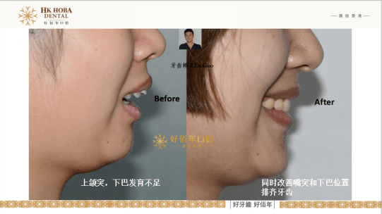 ??最新矯治器，重塑笑容的秘訣，輕松擁有完美微笑??