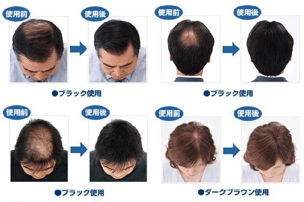 日本最新脫發(fā)解決技術(shù)揭秘，美麗之旅的心靈重塑與平衡