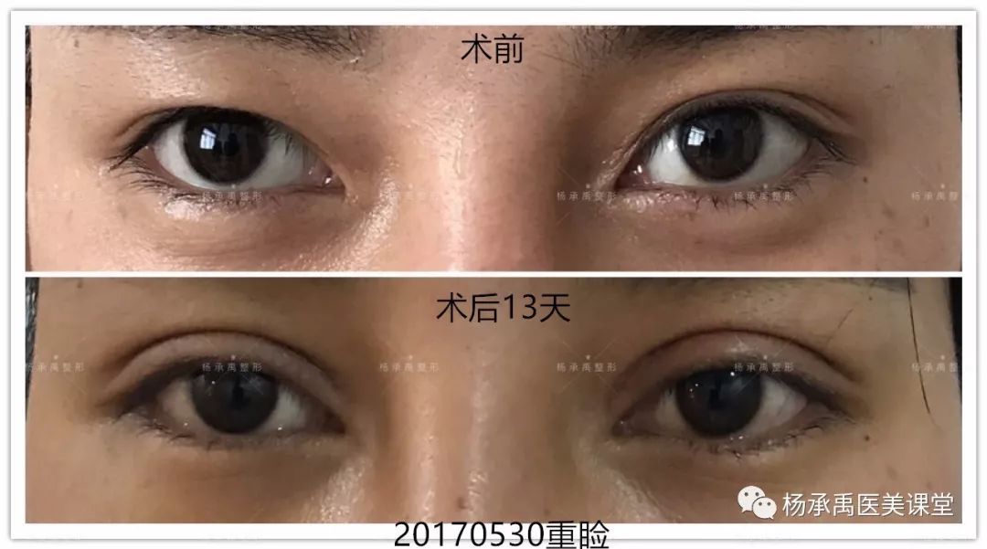揭秘現(xiàn)代黑眼圈成因與應(yīng)對(duì)之道，最新黑眼術(shù)解析