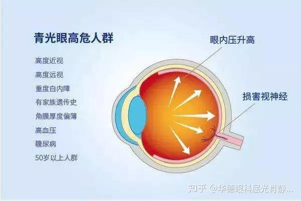 最新眼壓標(biāo)準(zhǔn)健康必看指南，了解眼壓，守護(hù)眼睛健康！