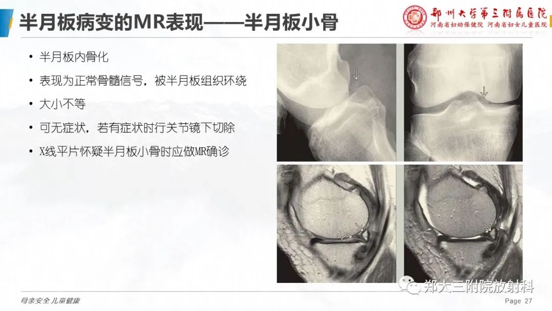 半月板再生研究最新進(jìn)展揭秘，科學(xué)突破助力恢復(fù)膝關(guān)節(jié)功能