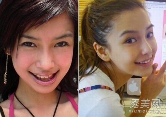 整牙明星，齒間改變鑄就人生光芒的勵(lì)志之旅
